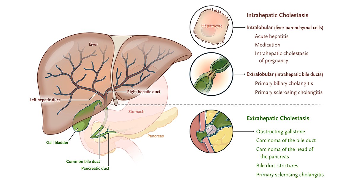 Cholestasis: An impairment in bile secretion or flow caused by intrahepatic or extrahepatic disease. nej.md/3SYwVW8