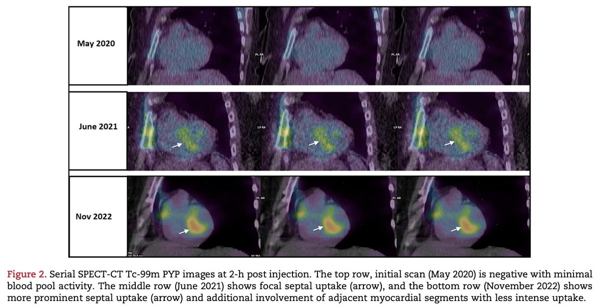 Progressive development of TTR cardiac amyloidosis by PYP imaging in a Ala-60 gene mutation carrier. @DrCAkincioglu @SchulichMedDent @WesternU #CVNuc #amyloidosis #ThinkAmyloid Learn more👉bit.ly/49Qj3EV