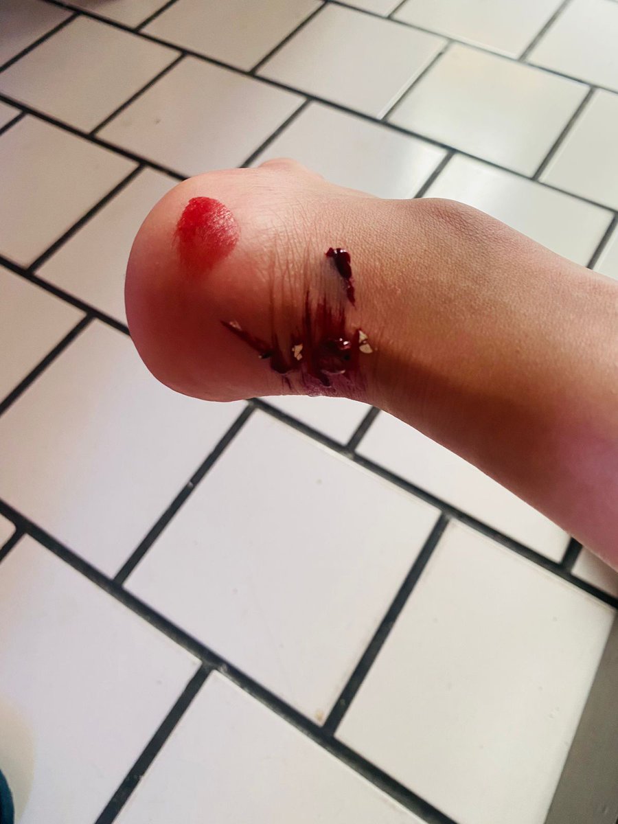SteffGm's tweet photo. Hoy me tropecé, y mi pie quedó atorado en la puerta, me astille horrible. Bonito sábado para mí https://t.co/j6psZ6rlGB