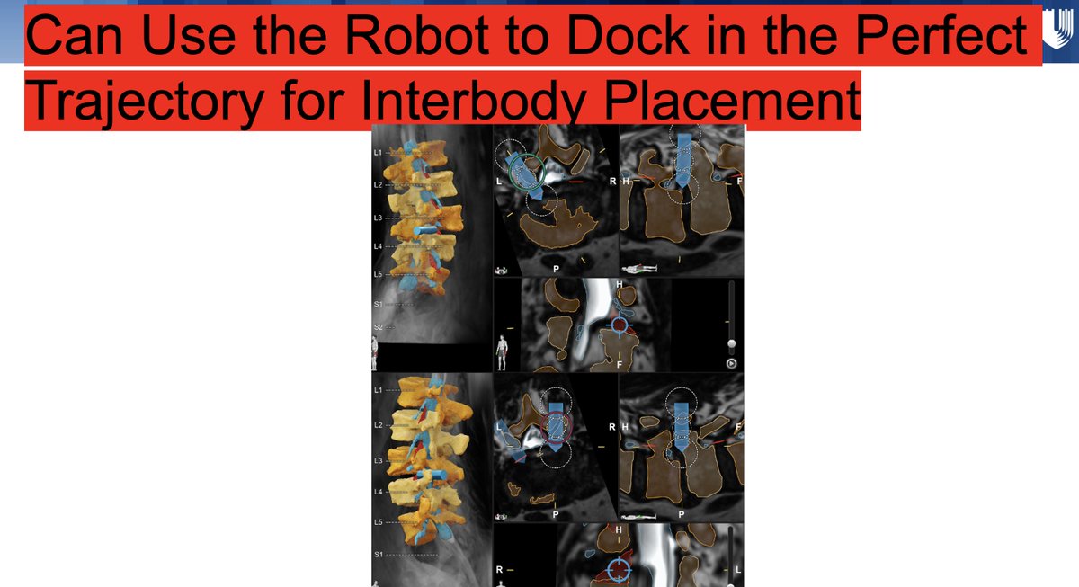 Looking forward to my talk southernneurosurgery.org/program-info On Advanced Robotics in Spine Surgery. Sneak Preview attached. Hint: we can use Robotics for so much more than pedicle screw placement. Thanks, @PeterFecci for invite! @Dukeneurosurg