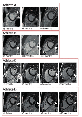 Long-term cardiac follow-up of athletes infected with SARS-CoV-2 after resumption of elite-level sports bit.ly/3uiD5rs