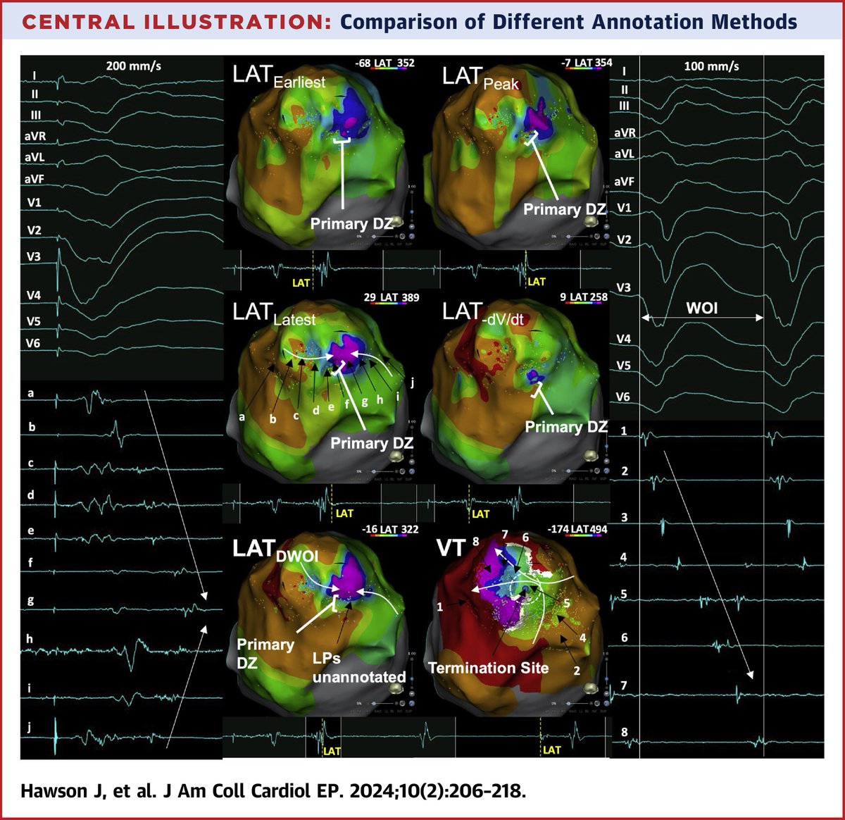 JACC Journals (@jaccjournals) on Twitter photo Annotation with LAT−dV/dt & LATDWOI are suboptimal in VT substrate mapping. <a href="/DrGeoffLee/">A/Prof GeoffLee</a>, et al propose that LATlatest should be the gold standard annotation method, as this allows identification of critical sites & is most suited to automation. bit.ly/3Ikardn #JACCCEP Annotation with LAT−dV/dt & LATDWOI are suboptimal in VT substrate mapping. <a href="/DrGeoffLee/">A/Prof GeoffLee</a>, et al propose that LATlatest should be the gold standard annotation method, as this allows identification of critical sites & is most suited to automation. bit.ly/3Ikardn #JACCCEP