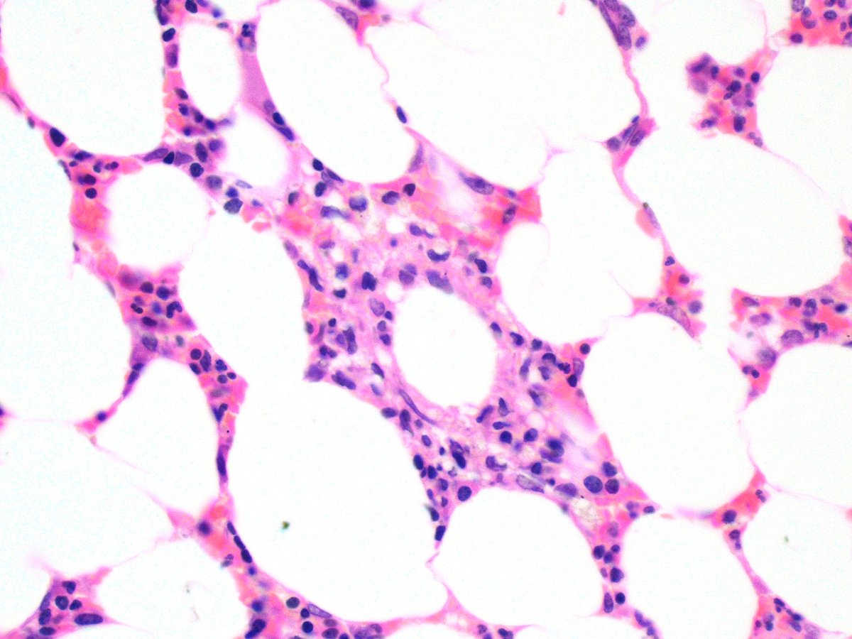 #hemepath Ring or 'donut' granulomas are best described in Q fever, although I have seen in them in COVID marrows as well