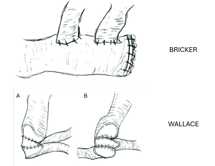 TheUrologyGuy's tweet photo. BRICKER VS WALLACE ureteroileal anastomosis for ileal conduit:

 - Bricker - end to side - two separate anastomoses to side of conduit 
 - Wallace - end to end - ureters joined together and placed on end of conduit 

Surgeon preference dictates the choice https://t.co/iRn69wUmwH