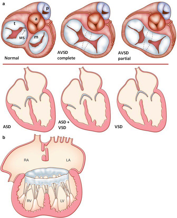 “ PM arrangements” Complete AV Canal 1. The positioning the posterior muscle farther from the septum than normal and 2. The anterior muscle closer to the septum. This papillary muscle arrangement, along with a Large anterolateral muscle bundle 👉🏻 progressive #LVOT_obstruction.