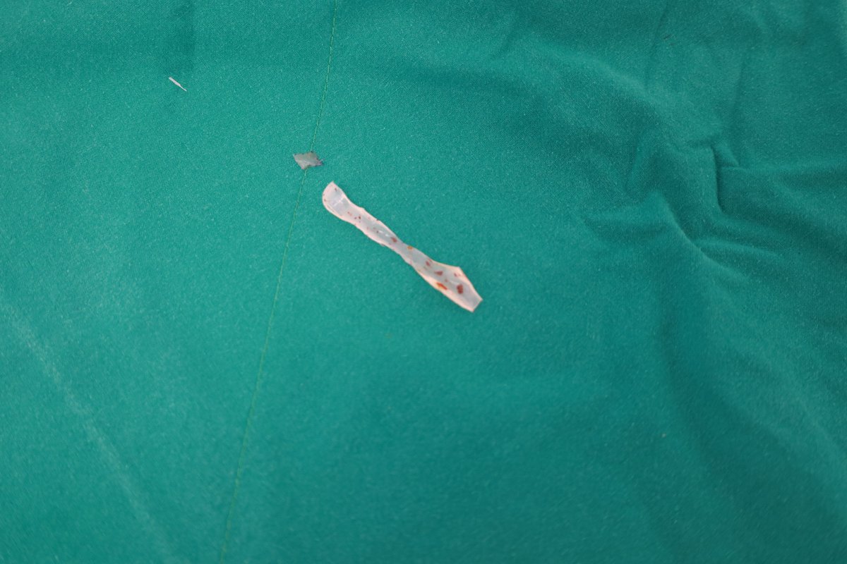 Today, I've performed revision rhinoplasty 🥰

This is her old nose implant.

#Rhinoplasty #Nosejob #แก้จมูก #ทำจมูก #鼻修正術 #鼻整形 #鼻再手術 #整形外科 #Rinoplastia #Rhinoplastie #Chirurgiedunez #nosesurgery #noseoperation #코성형재수술 #코성형수술 #جراحةتجميلالأنف #เสริมจมูก