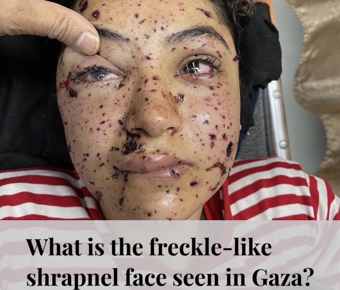 When bombs explode in Gaza, shrapnel (sharp fragments of buildings, metal, glass, or other materials) become projectiles, causing major facial injury.

This common injury in Gaza is called The Shrapnel Face.