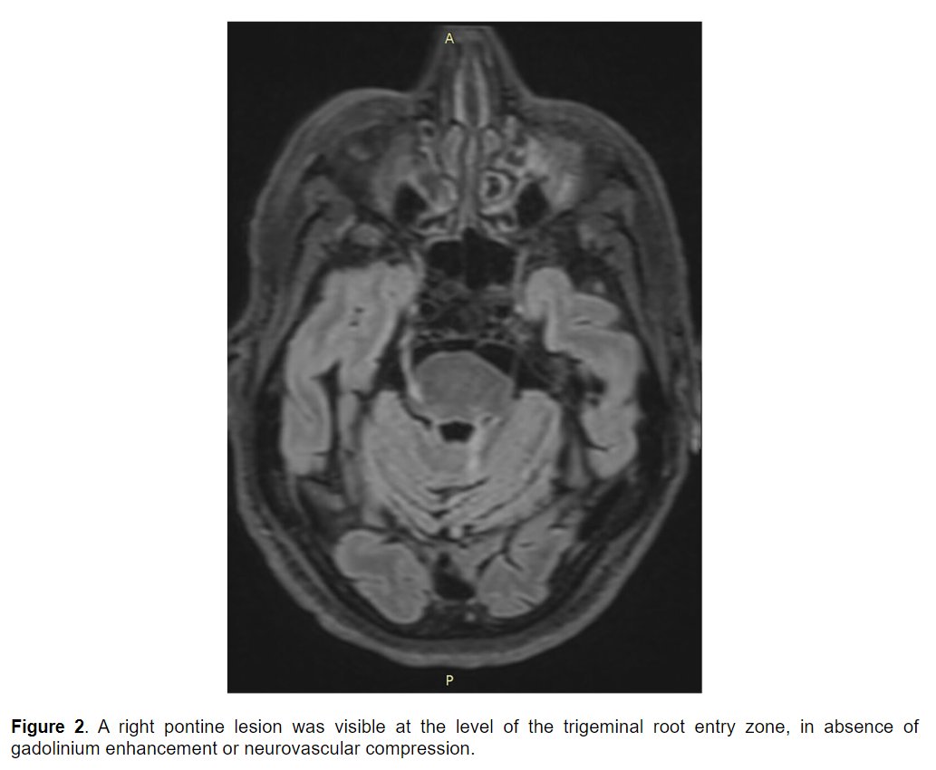 MSJ_Research's tweet photo. Pain is often poorly investigated in #MultipleSclerosis. Here is a case of short-lasting unilateral neuralgiform headache attacks with conjunctival injection and tearing #SUNCT secondary to trigeminal nerve lesion.
Case report from @SapienzaRoma ▶️ https://t.co/WweEBysGfg https://t.co/2egN7Wkymo