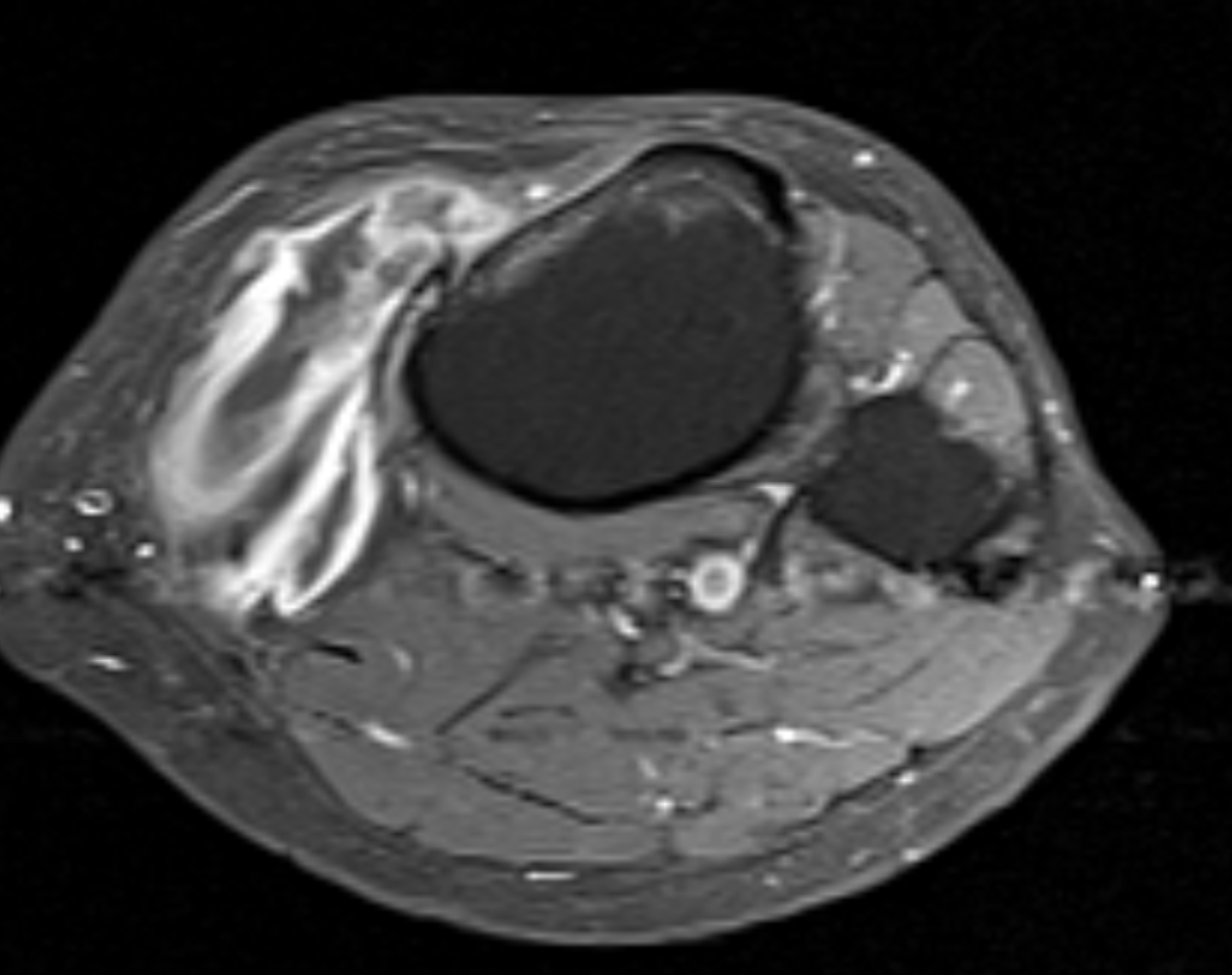Severe pes anserinus bursitis - Bursal fluid - Thickened bursal wall with avid enhancement - Reactive bone marrow edema anteromedial tibia