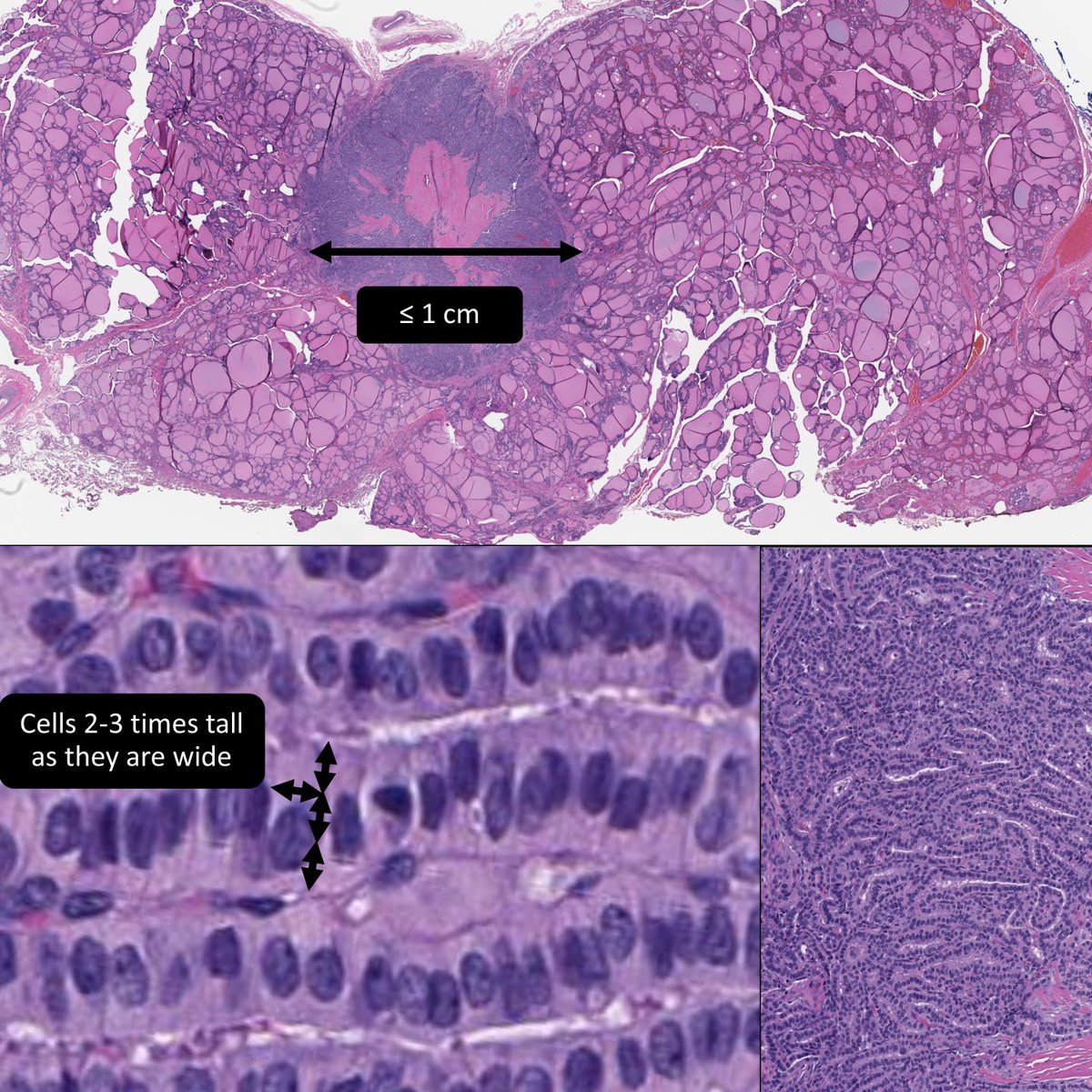 WHO diagnosis: ___ carcinoma
A) Papillary micro
B) Tall cell papillary
C) Tall cell papillary micro
#PathResidents #PathTwitter #EndoPath #ENTPath