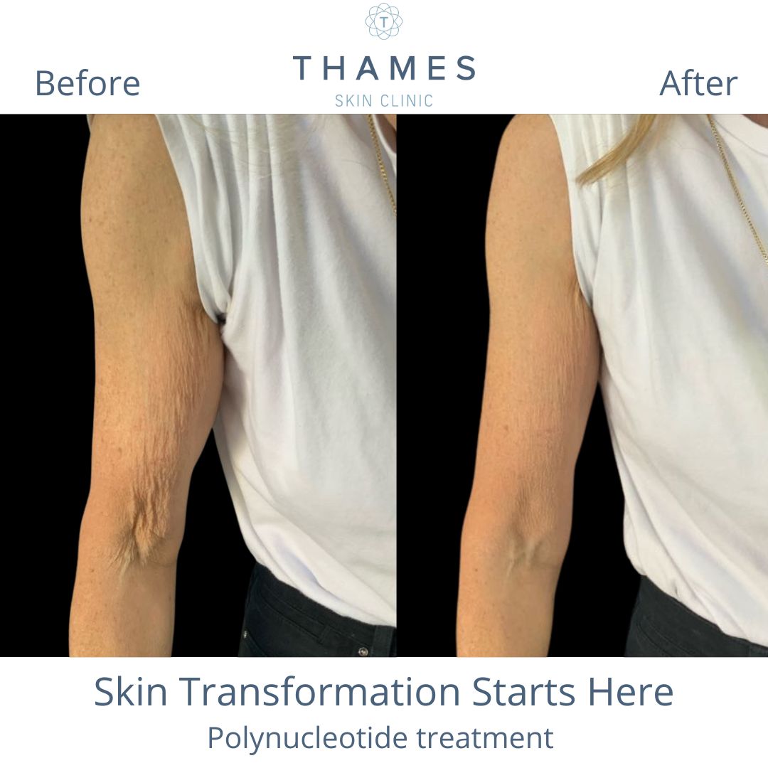 Polynucleotides are the latest revolutionary tools in regenerative medicine that work on a cellular level to repair tissue and boost skin quality. 💫 

This Thames Skin patient was very pleased with her results after an initial course of 4 😍 

#polynucleotides #dermafocus