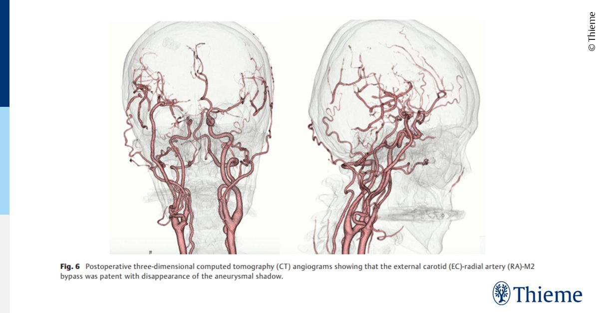 #OpenAccessSunday
🧠Read this rare case report about a NF1 patient with a giant thrombotic aneurysm and rapid progression of visual disturbance by M.Kobayashi, et al. !

thieme-connect.de/products/ejour…

#jnlsreports #skullbase #aneurysm #NF1 #visualdisturbance #neurosurgery