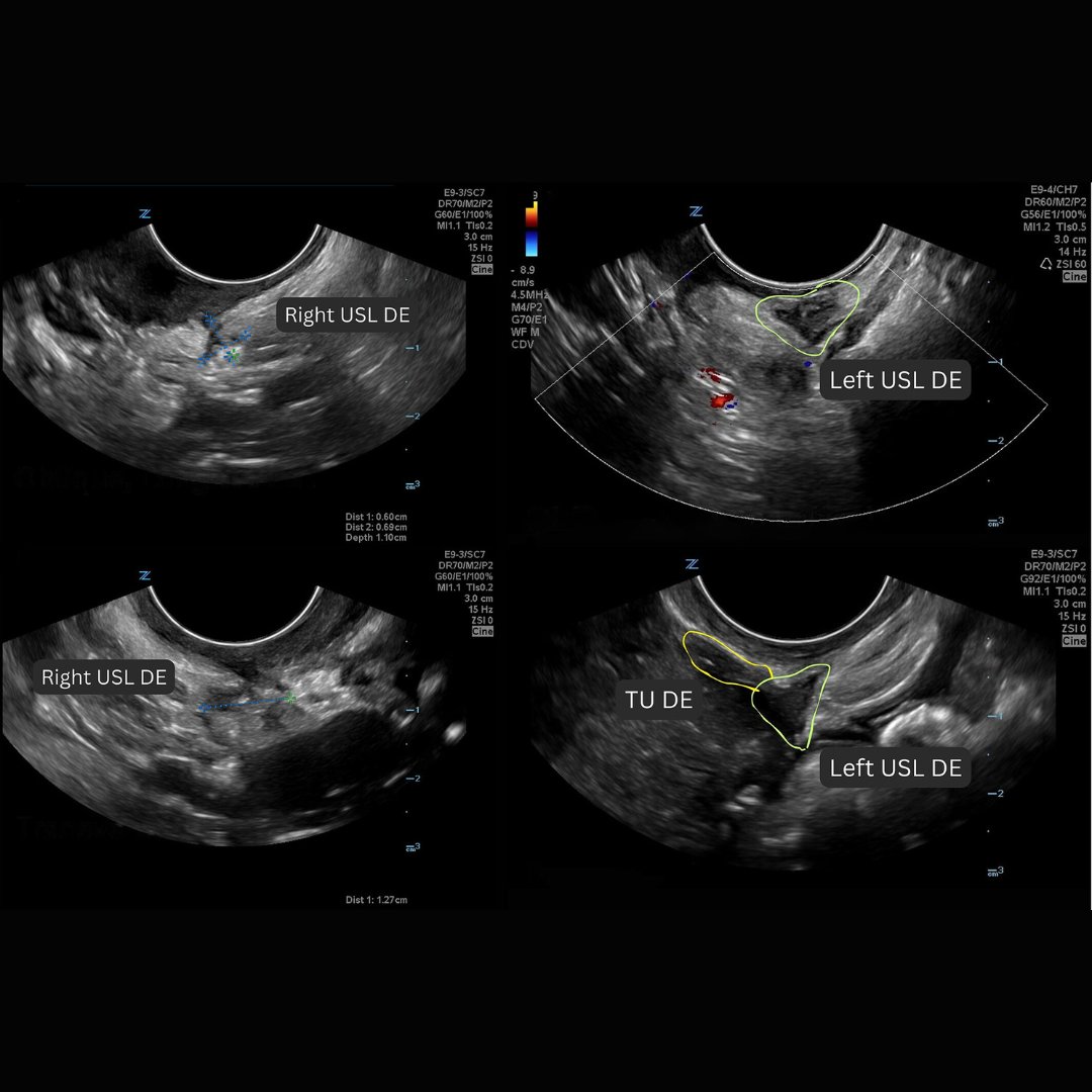 New open-access #UOGJournal study by Freger et al. shows that a standardized transvaginal ultrasound posterior approach has high diagnostic test accuracy for detecting deep endometriosis of the uterosacral ligaments and adjacent torus uterinus bit.ly/49zBJrM