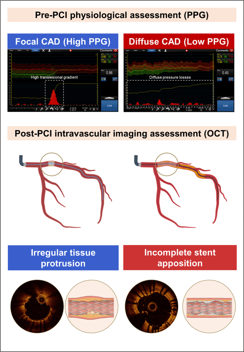 🔥What to expect after PCI in focal vs diffuse disease? 👉 High PPG (Focal) 🟰 Tissue protrusion 👉 Low PPG (Diffuse) 🟰 Underexpansion & incomplete stent apposition 👁️ Essential role of imaging (OCT) explaining outcomes in focal vs diffuse disease @PCRonline @JAHA_AHA Link👇