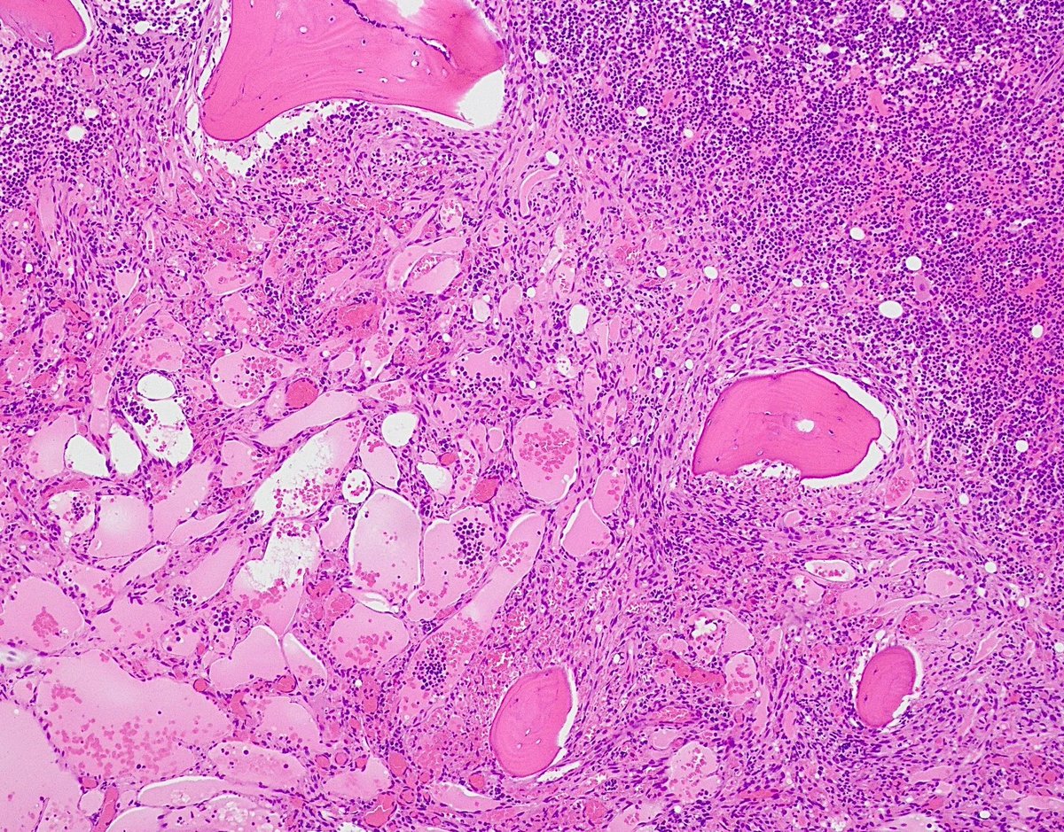 Bone marrow biopsy from a patient with untreated HIV revealing involvement by Kaposi sarcoma. Spindled tumor cells are seen forming irregular, dilated vascular spaces. What stain is positive in tumor cells? Answer: buff.ly/3fCYYdO   #PathTwitter #PathArt