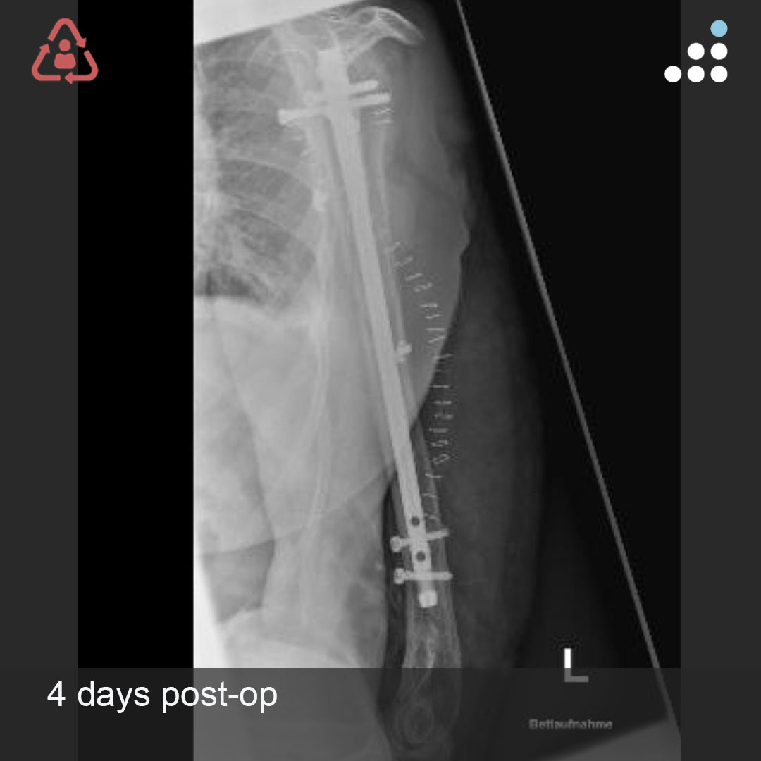 Cureus | Dynamic Compression Plating Versus Antegrade Intramedullary Nailing  for the Treatment of OTA/AO 12-A Fractures: A Retrospective Cohort Study |  Article