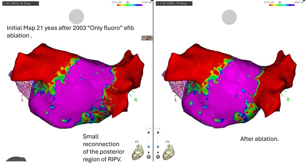 Friday case- 82yo pt, recurrence of PAF after 21 y post AF and flutter ablation (only fluoro, no 3D map) performed by @Scanav1Mauricio and Sosa in 2003 (@InCorHCFMUSP). Map after so many years: small recon of the RIPV. CTI line maintained with bidirectional block. Impressive.