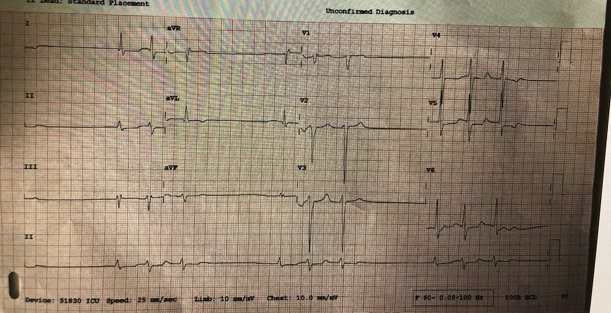 Interesting ECG. Thoughts @SergioPinski