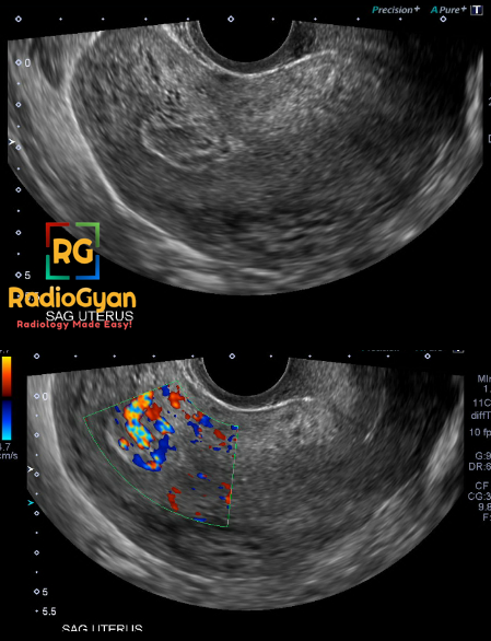 Hx: Bleeding post D&C. Diagnosis? Answer and discussion: bit.ly/3uX8znL #RGcases #radiogyan #RGlinks #radiology