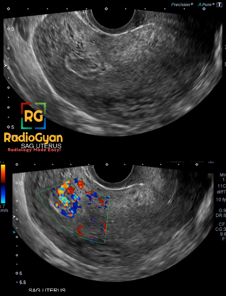 TeamRadioGyan's tweet photo. Hx: Bleeding post D&amp;C. Diagnosis?
Answer and discussion: https://t.co/GkoDzEc02o 

 #RGcases #radiogyan #RGlinks #radiology https://t.co/GXdhR2vF2X