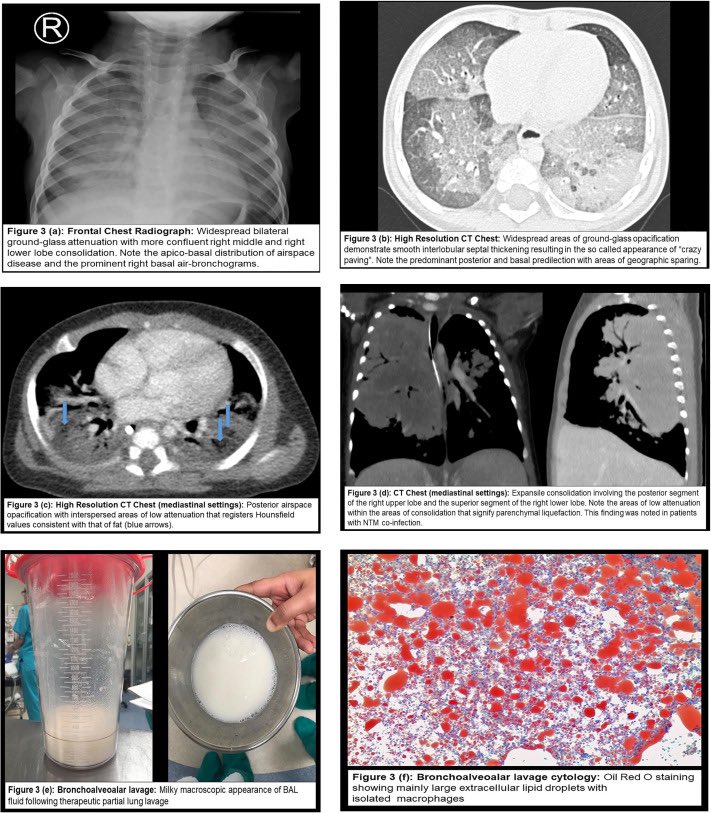 DrBassemKurdi's tweet image. كل كم شهر نواجه حالة صعبة جدًا من التهاب الرئة الشحمي lipoid pneumonia 
وسببها الأساسي لدى الأطفال هو الشرقة من تناول المواد الزيتية والدهنية 
ولذلك أتمنى عدم إعطاء الأطفال الرضع والصغار خاصة الزيوت مثل زيت السمسم أو زيت الزيتون أو السمن ليتناولوها مباشرة أو وضعها مع الحليب سواء…