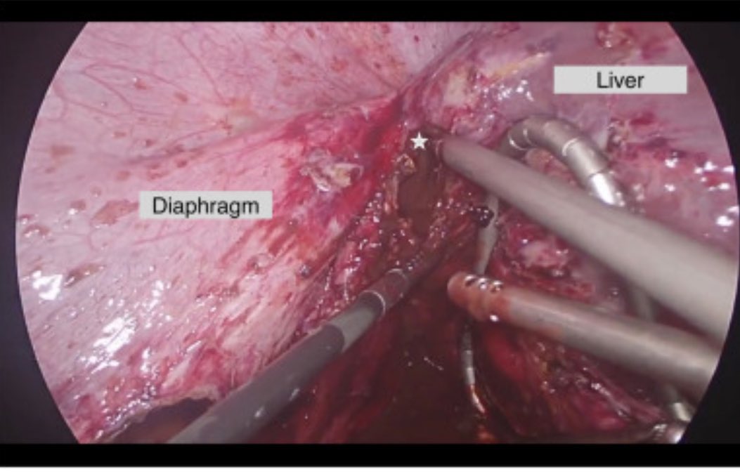 Liver endometrioma: a rare extrapelvic site of endometriosis causing catamenial right shoulder pain authors.elsevier.com/c/1iheKgm3zBgG

#EndometriosisAwarenessMonth