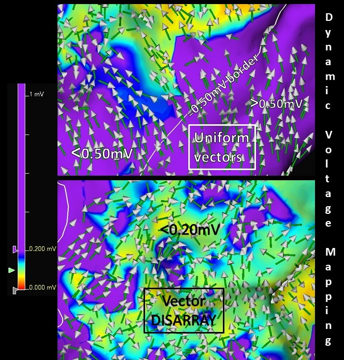 📢Calling all @AbbottCardio #ablateVT -Try playing “Omnipolar Vectors” on your substrate maps -You’ll see “Disarray” in scar (usually <0.20mV) -Introducing #DynamicVoltageMapping @LiverpoolEP @DrMarkMills to redefine borderzone 💻Now online @HRS_O2Journal heartrhythmopen.com/article/S2666-…