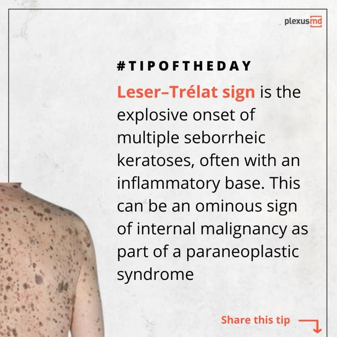 <a href="/drkeithsiau/">Keith Siau</a> Leser–Trélat sign  

Associated w/ GI adenocarcinoma; lymphoproliferative disorders; neoplasia of the breast; lung, urinary tract, &amp; ovarian cancer.  

<Image source: <a href="/plexusmd/">PlexusMD</a>>