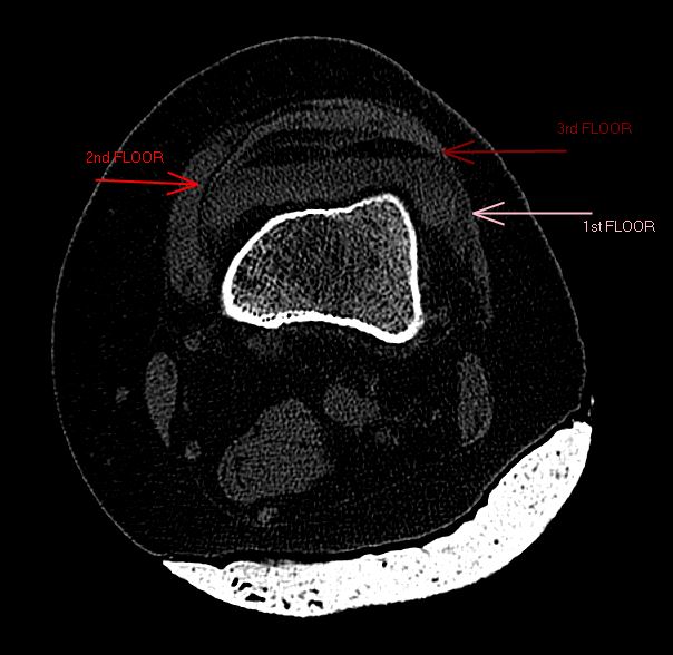 4/3/2024. 🟠Exploring the suprapatellar recess on an axial slice reveals a tri-level density phenomenon 🧐. Here's the breakdown: 1⃣What´s the explanation and the name? 2⃣What´s the representation of each floor? 3⃣What could be the cause? #MSKTrauma 🦵😀