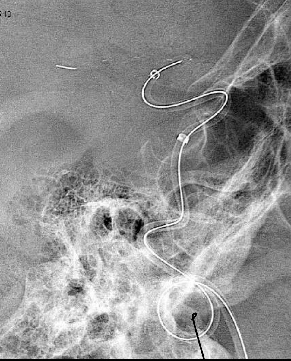 jagad002's tweet photo. Reconstructing a torn carotid artery. 4mm #Eric through #duo 156. #Sofia #Zoom 088 #LVIS blue. #imperativecare #Microvention #hcmc https://t.co/ap9jdP2qXb