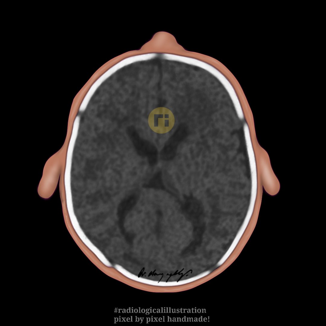 CHILD ABUSE IMAGING / 5 Sutures / 1 #radiologicalillustration ✍️