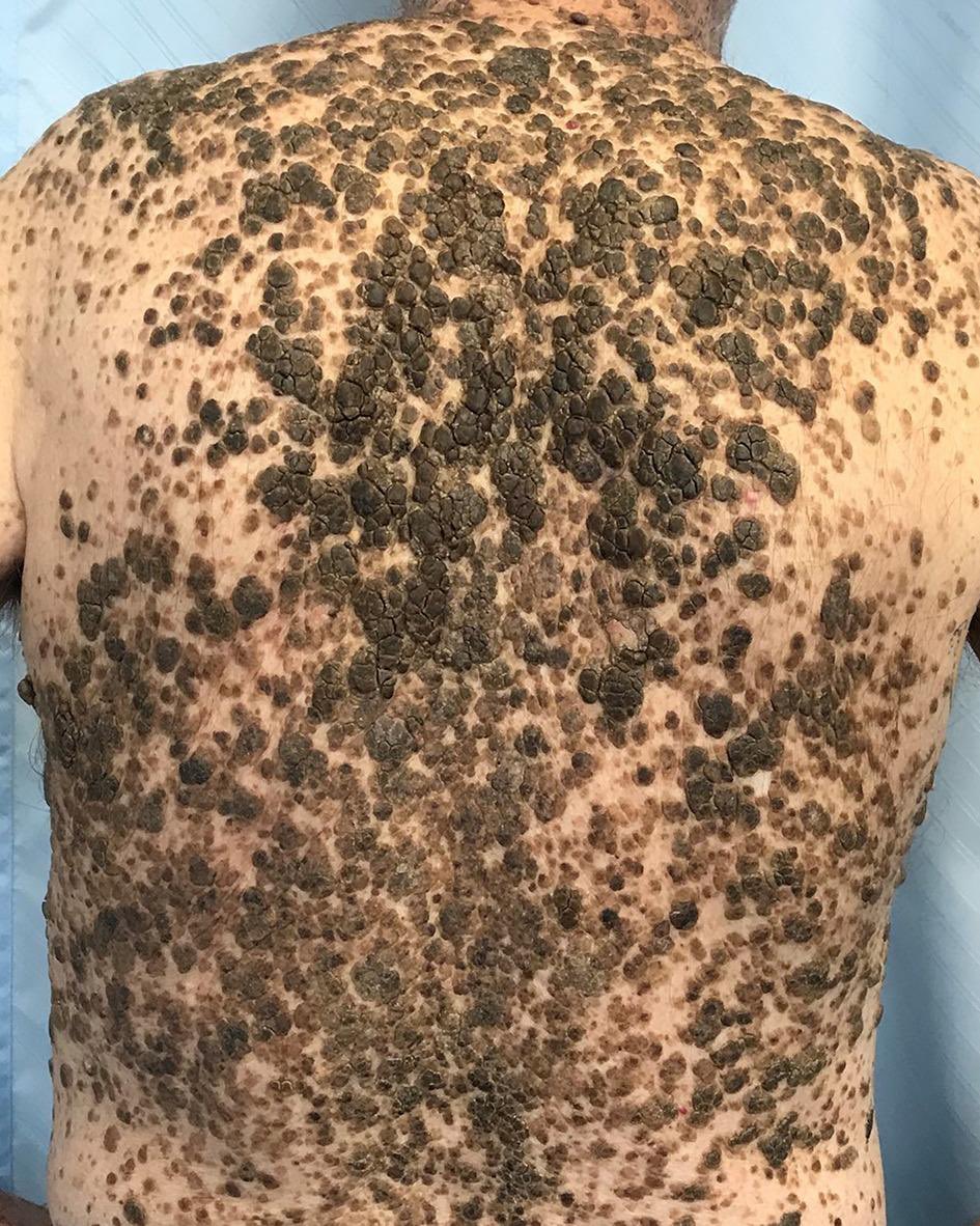 60M who has noticed this skin eruption over 6 months. What’s the diagnosis?
#ColorectalCancerAwarenessMonth