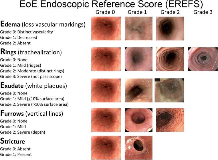 AGA_Gastro's tweet photo. Concepts and Controversies in Eosinophilic #Esophagitis: What’s Coming Down the Pipe ➡️ https://t.co/snNvZNAYEf https://t.co/a9cvZ63KsB