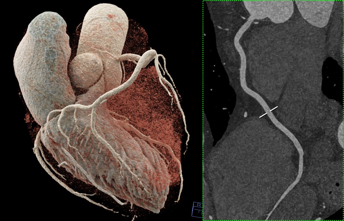 SOA PCCT - What can CT do for you and your patients? Cardiac imaging with PCCT is the diagnostic reference standard for any anatomical investigation. 3D Cinematic Rendering + cMPR of RCA. Ex. 1024x1024 matrix; source images 0.2/0.1mm; thickness/increment. Kernel Bv60. QIR 4.