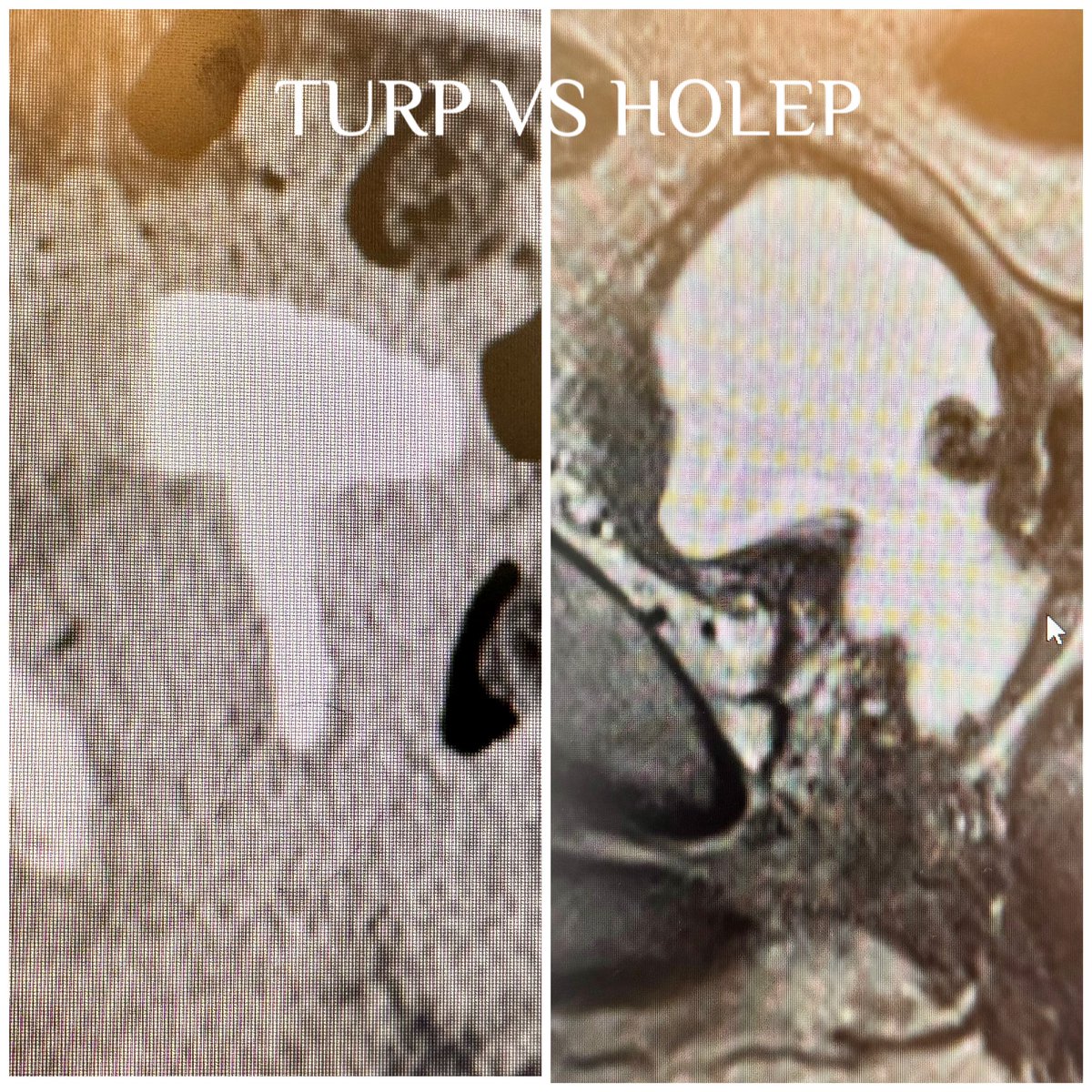 TURP vs HoLep