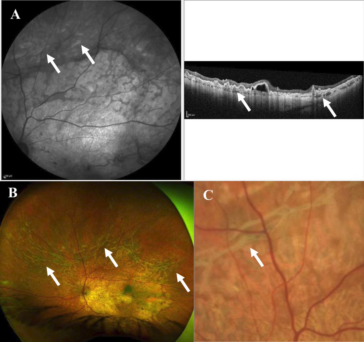 A new study finds that outer retinal corrugations can be a clinical and diagnostic feature of Late-onset #retinal degeneration (L-ORD) on #OCT. Read more here: bit.ly/3v7ahmO #retina #ophthalmology #vision #eyes #genetics #imaging #health