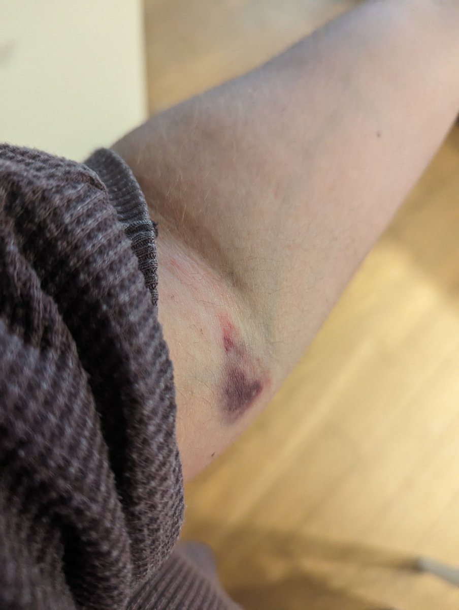 NavieRula's tweet photo. I'm truly disappointed in @onemedical. I went for a blood draw for my annual exam and the person that took my blood was unskilled and caused a clot in my arm. I went to see a provider for a follow-up and they didn't help me except by saying, "it will go away." 🙄 https://t.co/sgGKsGeWsR