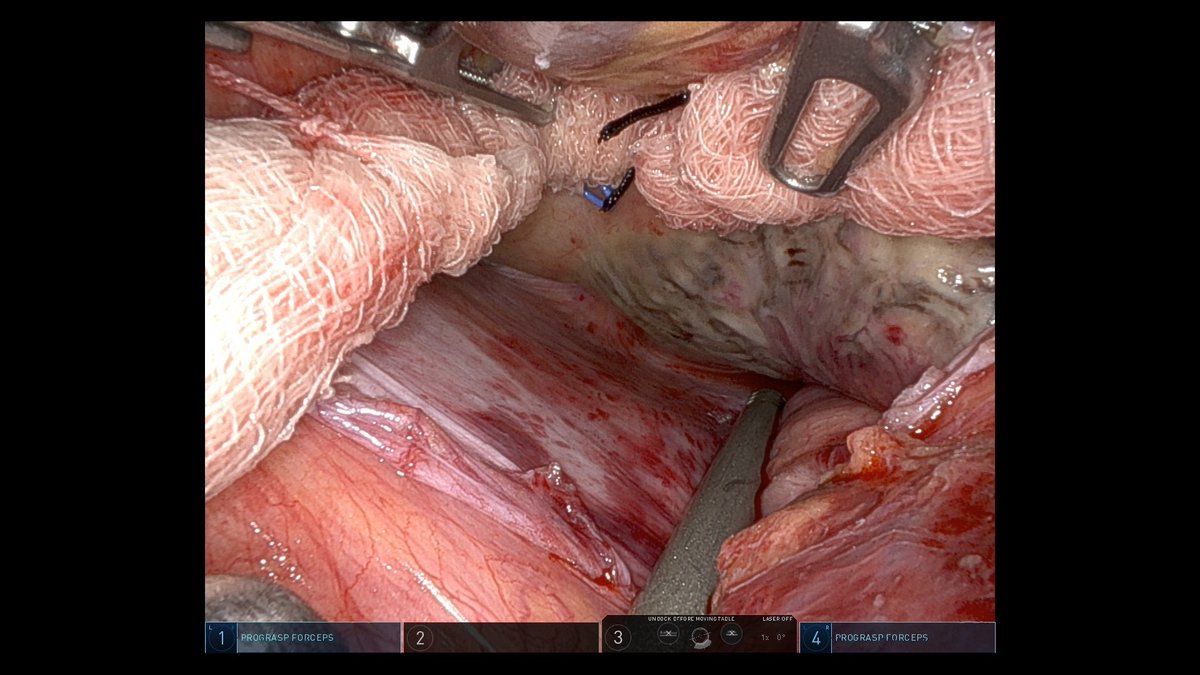 Another milestone in our robotic practice. Robotic assisted hybrid atrial fibrillation ablation (with EPi-Sense ST™). Only 5 port size incisions and patient dismissed the next day! #roboticcardiacsugery #hybridablation @MayoClinicCVS @akillumd @dralansugrue