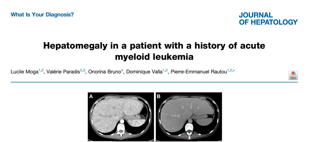 A 30-year-old man referred for hepatomegaly and with a “mosaic” enhancement pattern at the arterial phase at CECT. History of bone marrow transplantation 9 years earlier. What is your diagnosis? See more here: authors.elsevier.com/a/1imHYcOnAQzZt