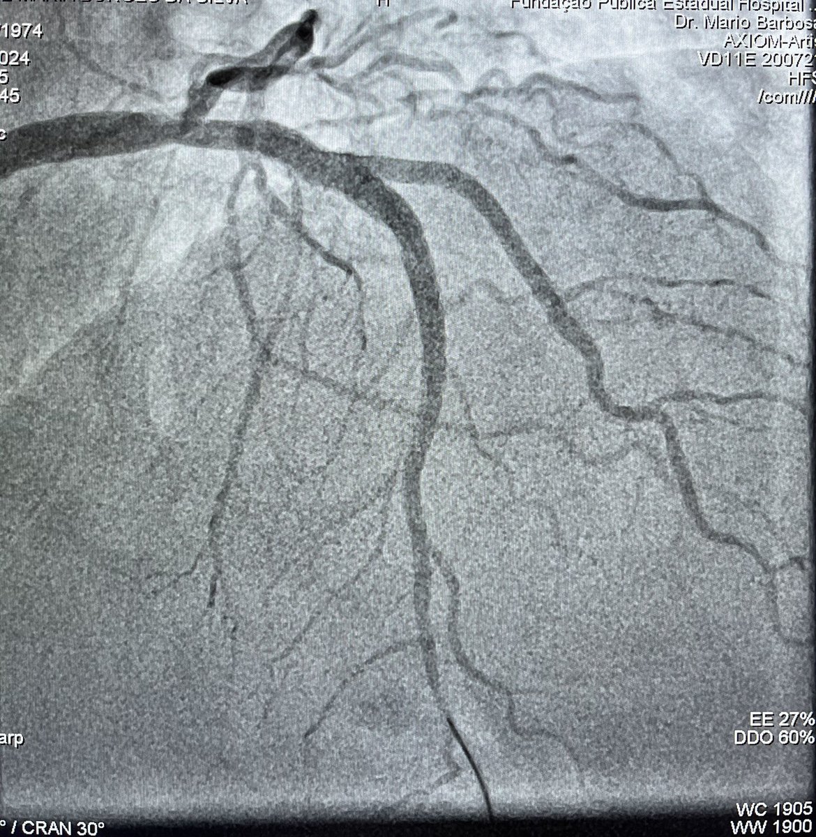 49y 👩🏽. Lupus.

NSTEMI V1-V6 deep and symmetrical T wave inversion.
Kicking off the weekend!