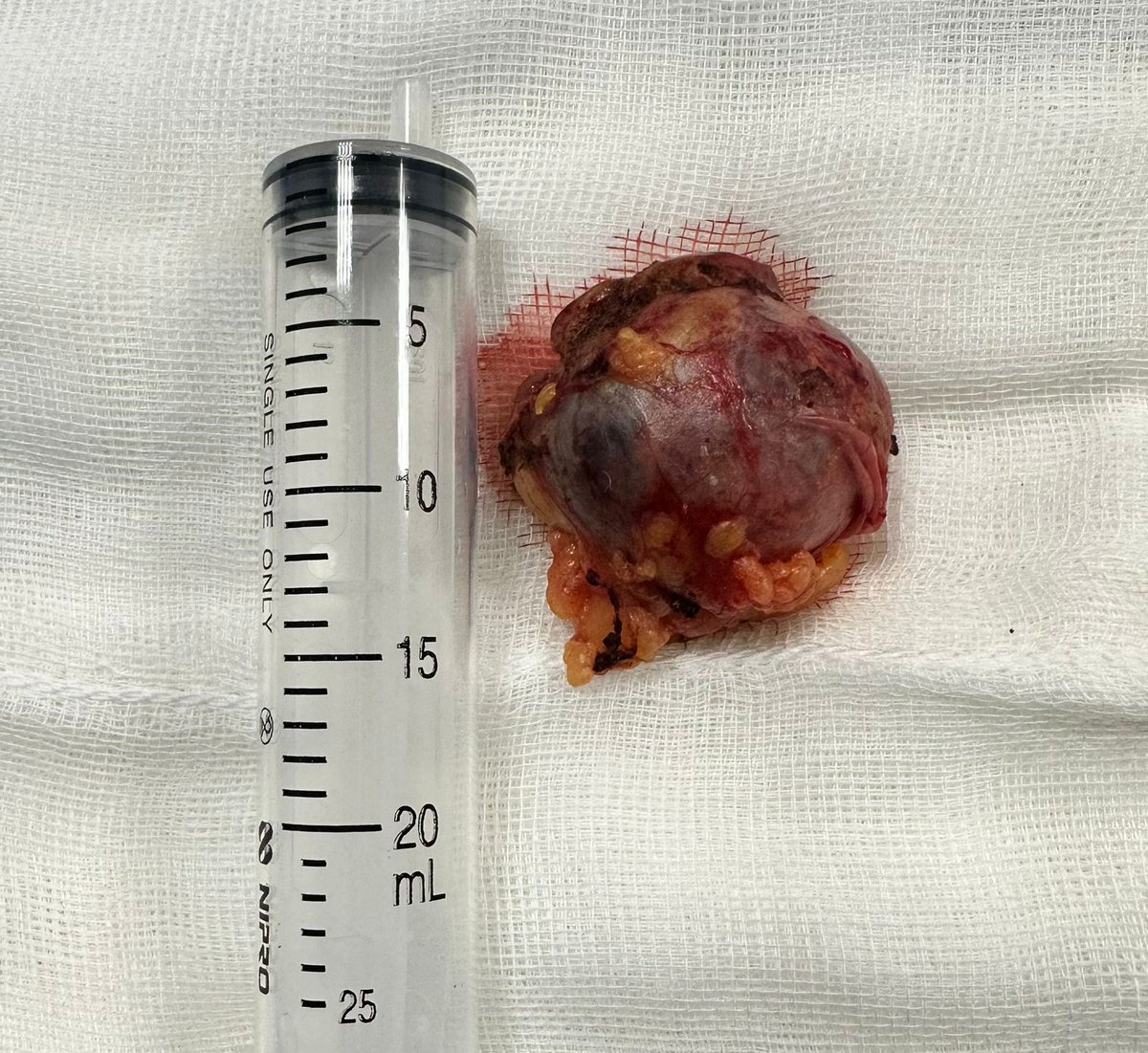 UTR_DrHuerta's tweet photo. Nefrectomía preservadora de nefronas. https://t.co/whqgfBHcQb