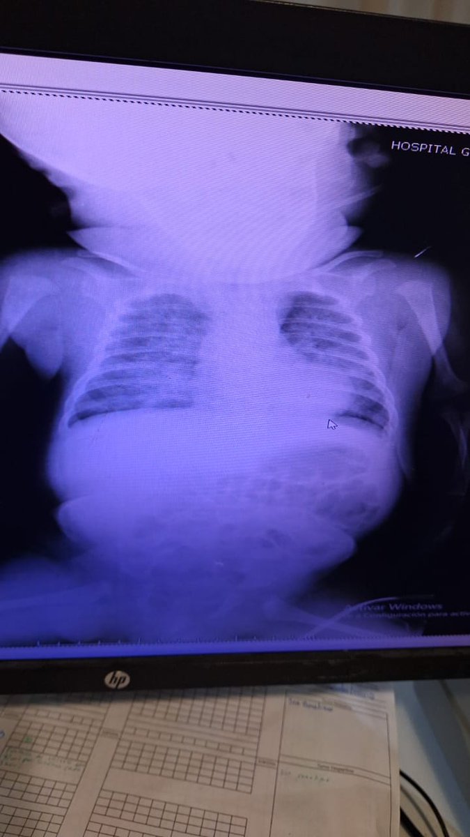 DSPedia21's tweet photo. Caso del dia... Masculino de 3 meses de edsd, acude por dificultad respiratoria, y fiebre de 24 horas de evolución. Vacunas completas, la madre refiere que desde hace 15 dias da papillas de frutas y aceite de oliva ( para los colicos)
Idx?????? https://t.co/BU88LSiyj1