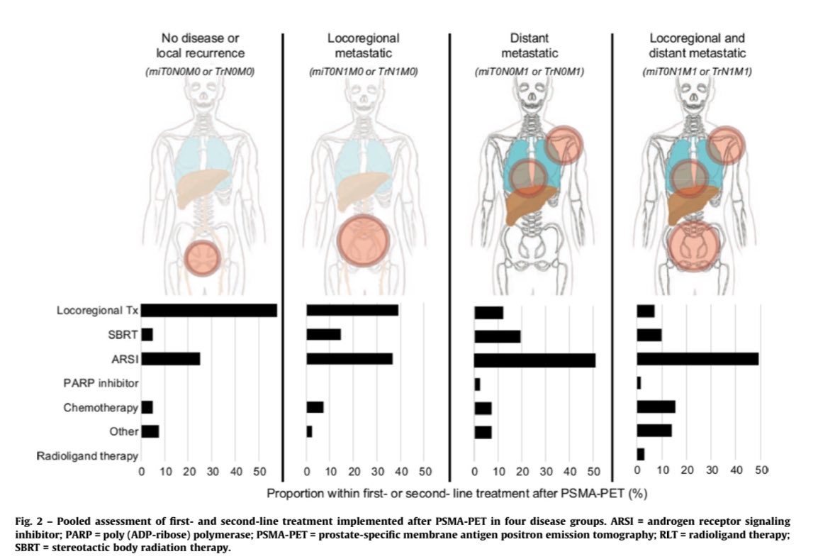 ➡️ Polymetastases (5+) on #PSMA-PET + initial pN1 status are associated with shorter OS #nmCRPC
➡️ PSMA-PET disease extent results in additional risk stratification @EUplatinum 
Thank you for integrating me in this great collaboration #WolfgangFendler #ManuelWeber👇