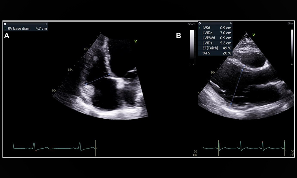 ASE360's tweet photo. In this @CASEfromASE report, we present a patient with a history of Ross procedure who developed anginal symptoms 25Β years after the index surgery. https://t.co/6L6Qm10Vno
#CASESpecialIssue #10DaysofCase #ACHD https://t.co/PT3wbSEkOJ