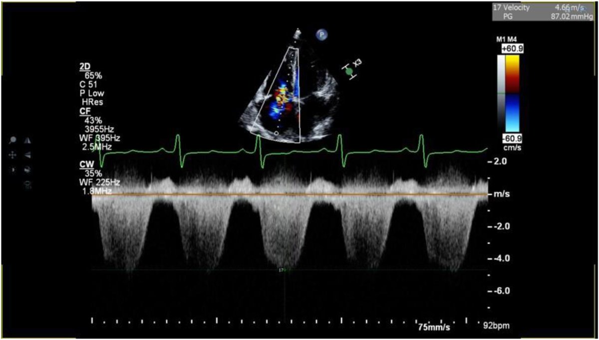 We describe a case of a patient with a previously unidentified patent ductus arteriosus presenting during the 3rd trimester of pregnancy complicated by biventricular dysfunction and severe PH. bit.ly/49VoYZc #CASESpecialIssue #10DaysofCASE #ACHD