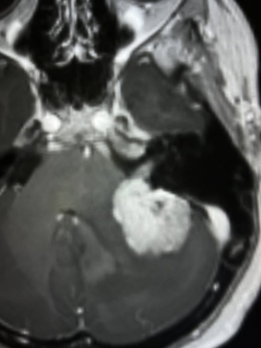 Enhancing CP angle tumors: When the icecream (tumor) doesn’t fit perfectly central to the cone (IAC), it’s not Schwannoma. It’s usually meningioma. —reporting list