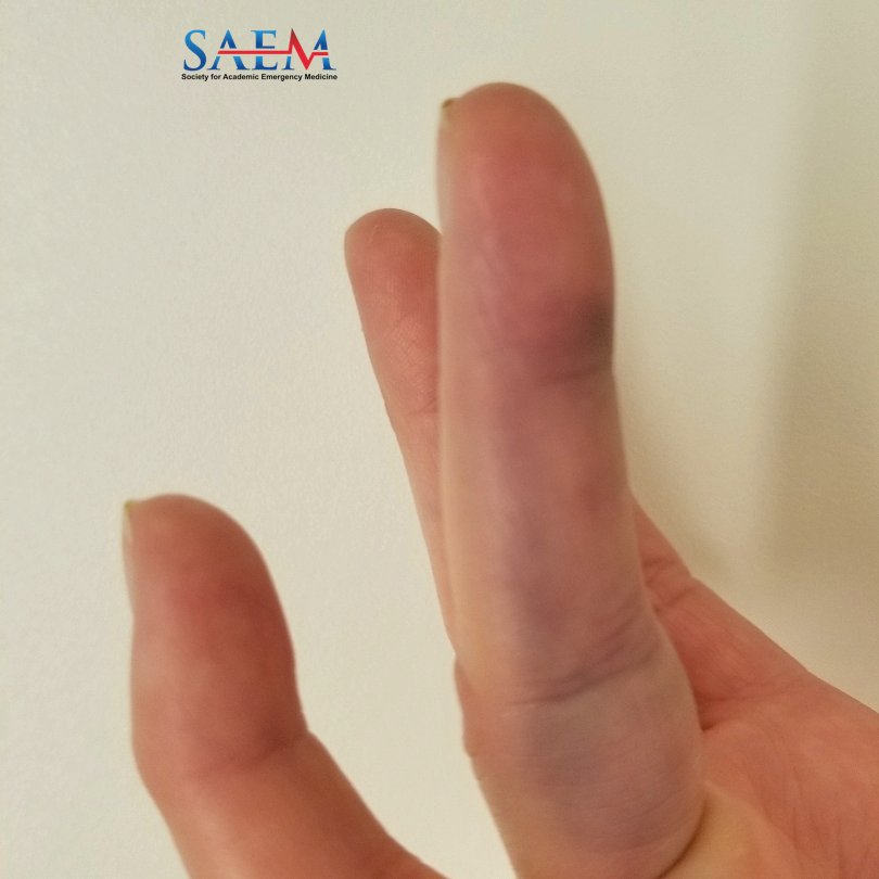 SAEM Clinical Images Series: Purple Finger What would you do to work up a spontaneously bruised finger? Should you do anything? aliem.com/saem-clinical-… @SAEMonline