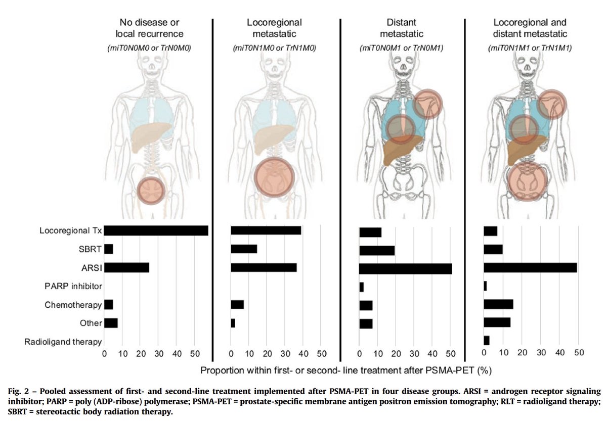 DrMHofman's tweet image. We followed up the patients in the 2019 highly cited first description of PSMA PET/CT findings in "non-metastatic prostate cancer" to see what happened with overall survival... Polymetastatic disease [≥5 metastasis] on PSMA PET/CT** was associated with shorter survival.  

**…