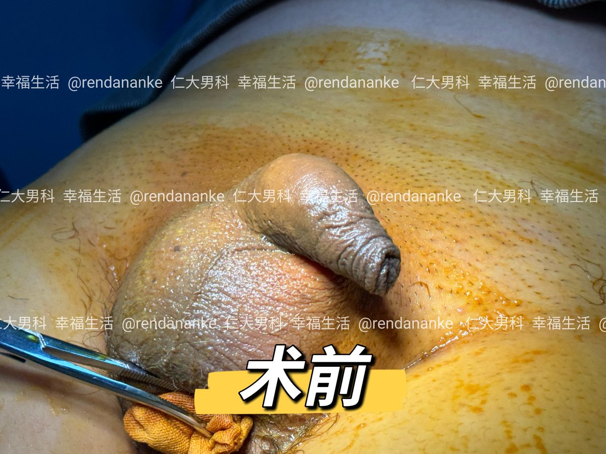 rendananke's tweet photo. 上海小伙，2024年3��17日，包皮手术合并生物补片增粗手术！ https://t.co/TGV7DpjaDw