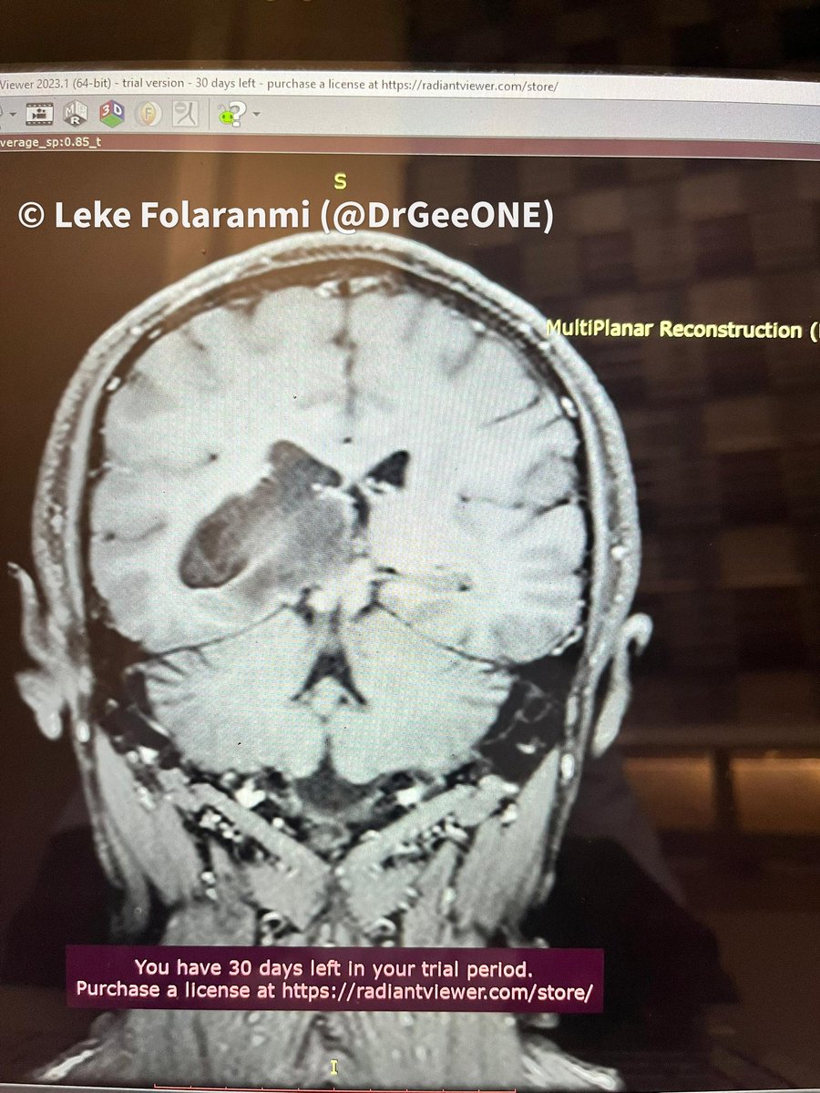 DrGeeONE's tweet image. Kindly share your thoughts on this case: Intraventricular mass in a 38 year old Male. 1/2
@CraigHorbinski
@neuropathmk @bitar_mireille
@mlage @FRodriguezNP #CNSPath #NeuroPath #PathTwitter #PathX